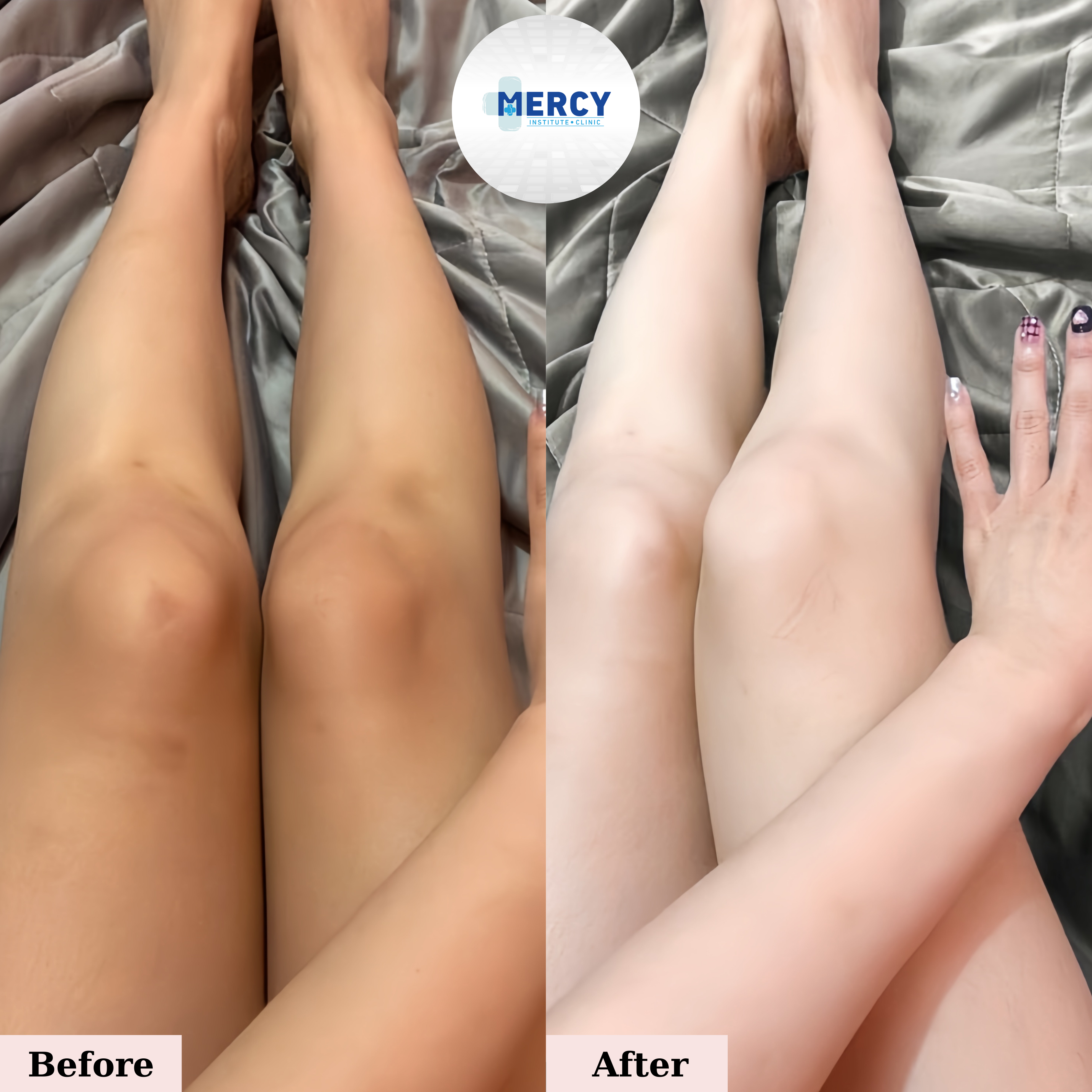 Whitening Treatment